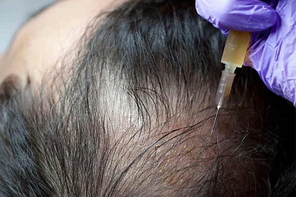 PRP Therapy: Effective Hair Fall Control