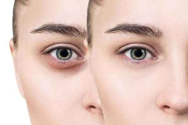 Identifying and Addressing Causes of Dark Under Eye Circles
